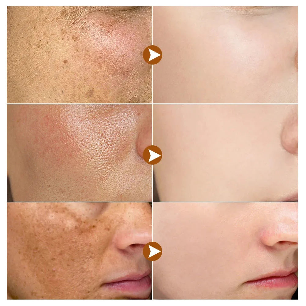 Niacinamide Whitening Freckles Serum Removal Melasma Dark Spots Lighten Melanin Pigmentation Brightening Anti-Aging Skin Care