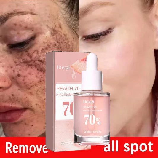 Niacinamide Whitening Freckles Serum Removal Melasma Dark Spots Lighten Melanin Pigmentation Brightening Anti-Aging Skin Care