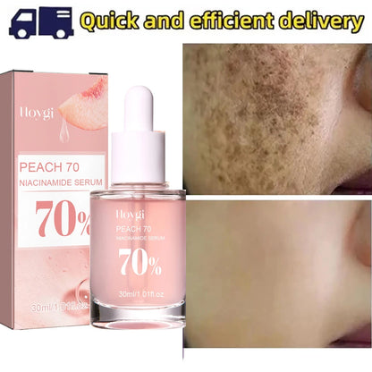 Niacinamide Whitening Freckles Serum Removal Melasma Dark Spots Lighten Melanin Pigmentation Brightening Anti-Aging Skin Care